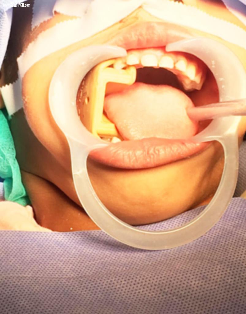 قسم الأسنان بمستشفى شرق جدة يتأهل للصدارة بتقديم كامل خدماته للمرضى