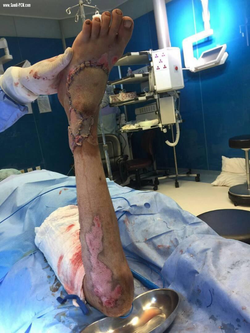 مستشفى الملك فهد بجدة ينجح في نقل شريحة جلدية لشاب سعودي تعرض لحادث مروري