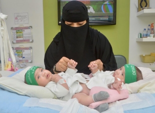 دكتور الربيعة : عملية فصل التوأم السيامي السعودي شيخة وشموخ 	 غدا  الخميس 25 اكتوبر