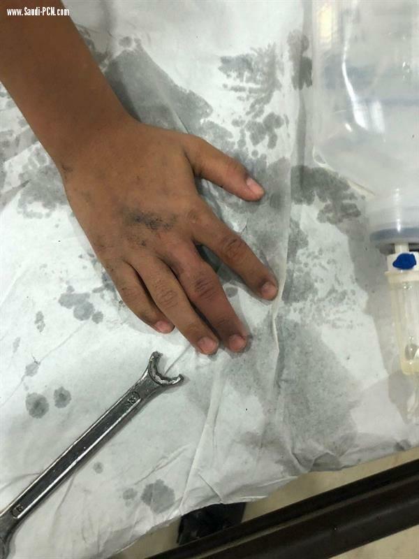 الرياض.. الدفاع المدني ينقذ «إصبع طفل» بعد فشل الأطباء (صور)