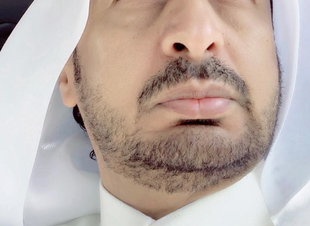 المخدرات  .. تتساقط كما يتساقط ( المفسدون ) 